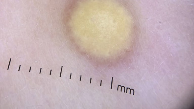 Gelbe Papel auf dem Rücken eines Säuglings Abb. 1