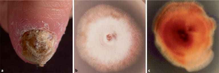 Pilzinfektionen der Haut bei Kindern