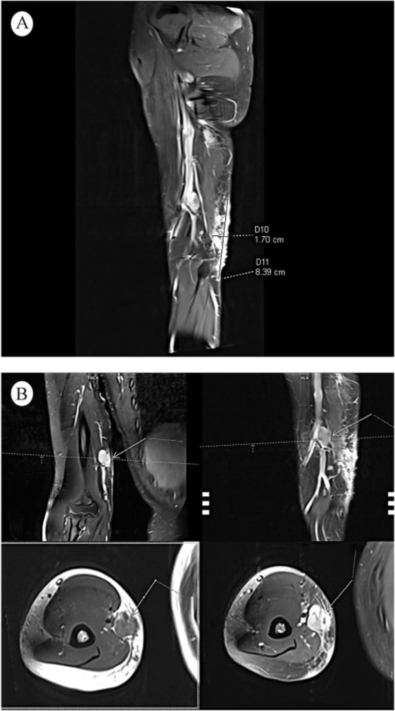 Magnetresonanztomographie (MRT) der oberen Extremität