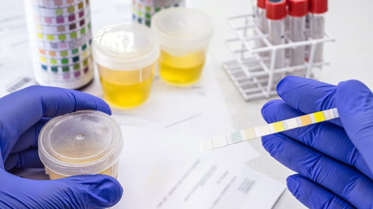 Früherkennung von Demenz durch Urintests