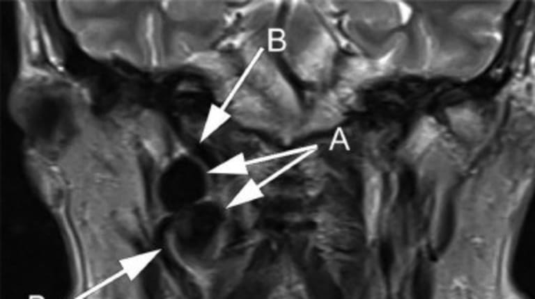 Glossopharyngeusneuralgie?