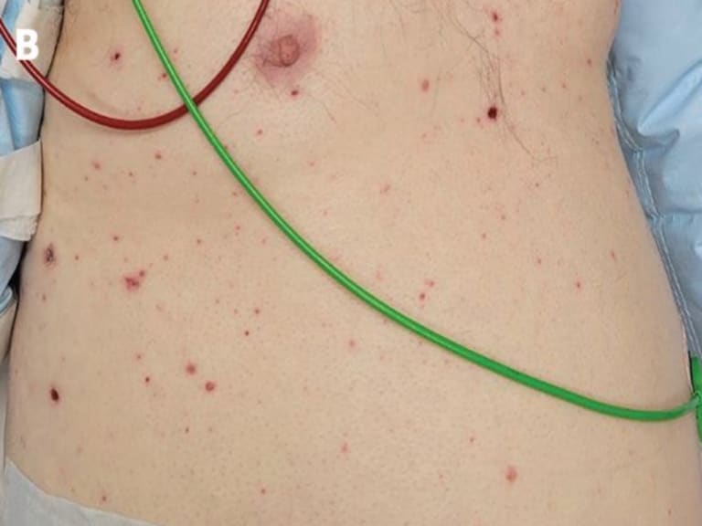 Bläschen und erythematöse Papeln am Rumpf und an den Gliedmaßen 