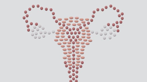 Sentinel-Lymphadenektomie bei frühem Zervixkarzinom: Ein neuer Standard?