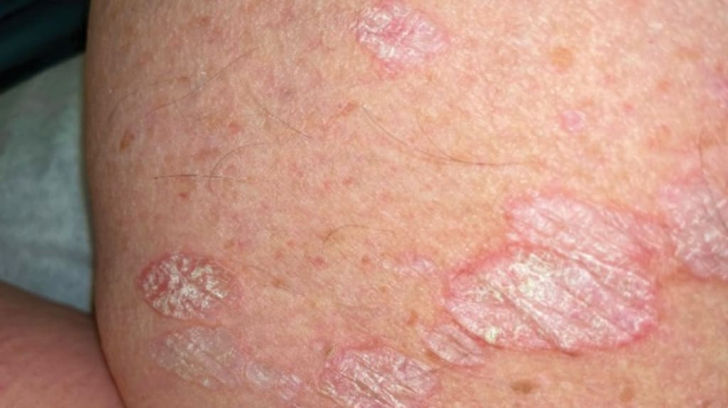 Weiße Flecken Oberschenkel