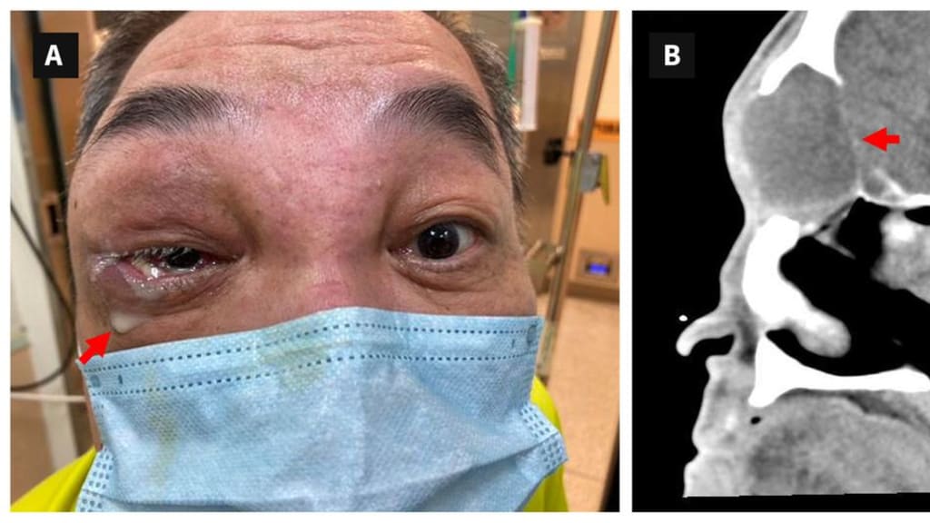 Bild der Woche Geschwollenes Auge