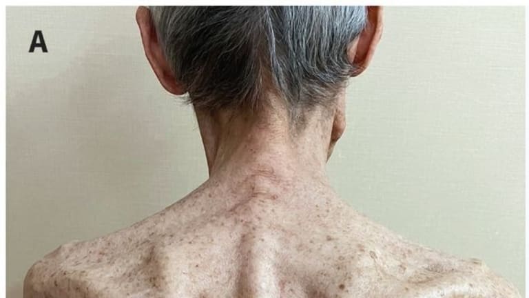 Ausgeprägter Muskelschwund im Bereich der Schulterblätter bei einem 81-jährigen Mann