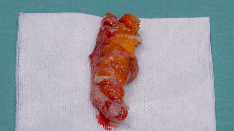 Laparoskopische Appendektomie Header