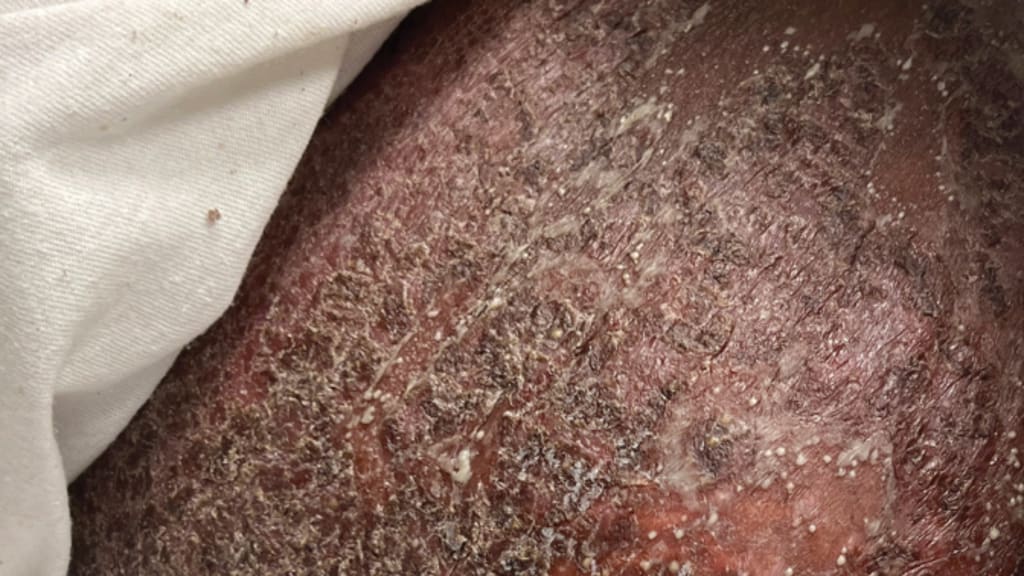 17-jährige Schwangere mit erythematösen Pusteln und Plaques