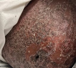 17-jährige Schwangere mit erythematösen Pusteln und Plaques