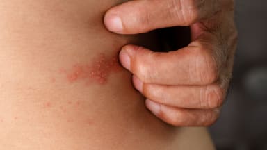 Was verbindet atopische Dermatitis mit Gürtelrose?
