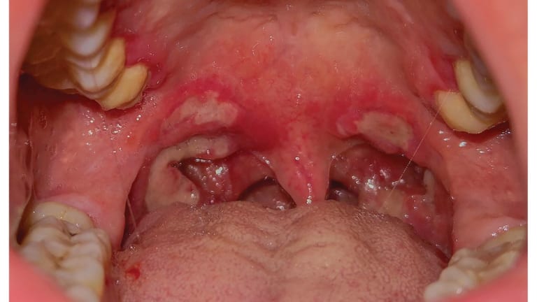 Grau-weiße Plaques im Oropharynx eines 35-Jährigen