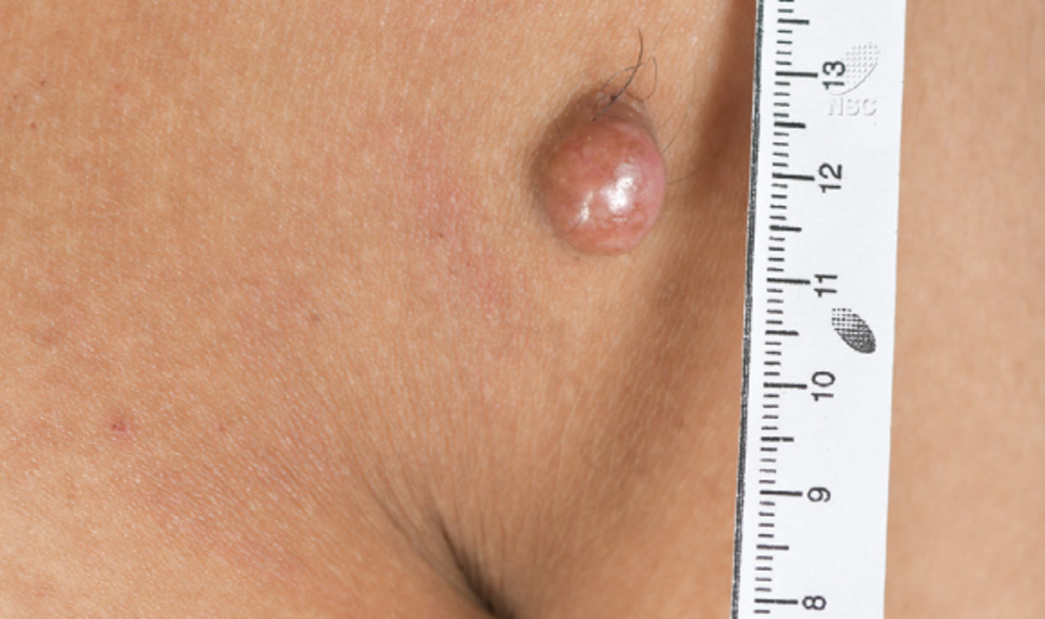 Roter Knoten auf der linken Schulter mit Größenvergleich