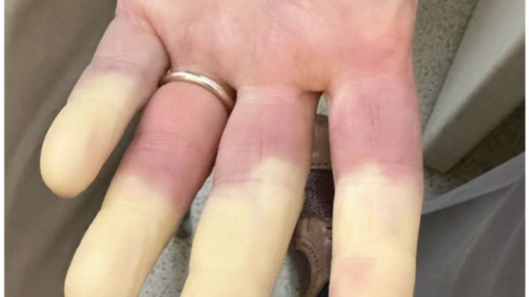  Abgrenzung zwischen distaler Blässe und proximaler Zyanose an vier Fingern