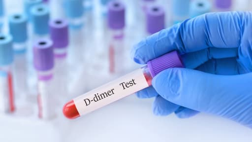 Tiefe Beinvenenthrombose: Weniger Sonografien durch alterspezifische D-Dimerwerte 