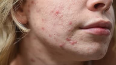 young woman acne close up face