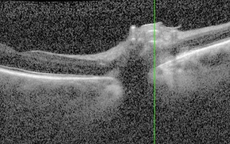 Beidseitige Papillenschwellung Abb. 5: OCT-Aufnahme des rechten Auges mit Rückgang der Papillenschwellung