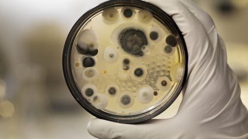 Patientenfall: Isoliertes renales Aspergillom