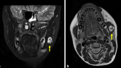 Natives Kopf-Hals-Magnetresonanztomogramm 