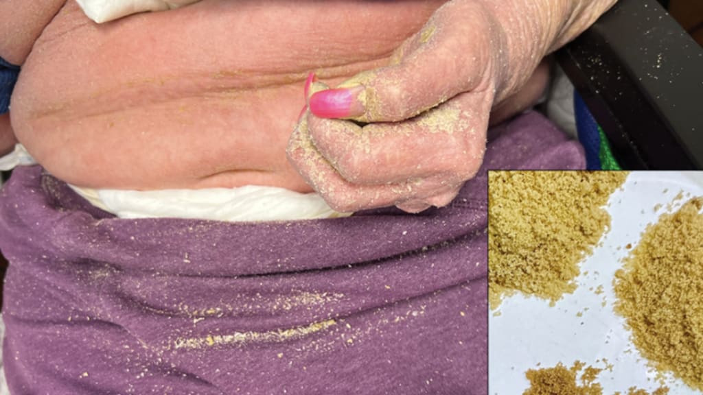 Hautabschürfungen, die an braunen Zucker erinnern