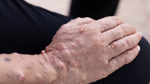 Mirdametinib bei Neurofibromatose Typ 1 mit plexiformen Neurofibromen