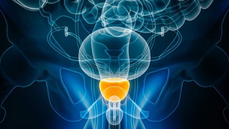 Prostatakrebs: Umbenennung von Niedrigrisiko-Tumoren könnte Übertherapien verhindern