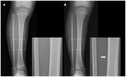 Röntgenaufnahmen des rechten Unterschenkels eines 3-jährigen Mädchens, aufgenommen (A) am Tag der Verletzung und (B) 11 Tage nach der Verletzung.
