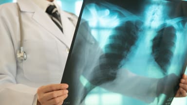 Tocilizumab bei schwerer, steroidrefraktärer Osimertinib-induzierten Pneumonitis