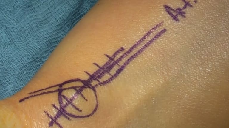 Ganglionektomie bei palmaren Handgelenkganglion