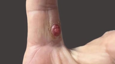 Rote Läsion am Finger