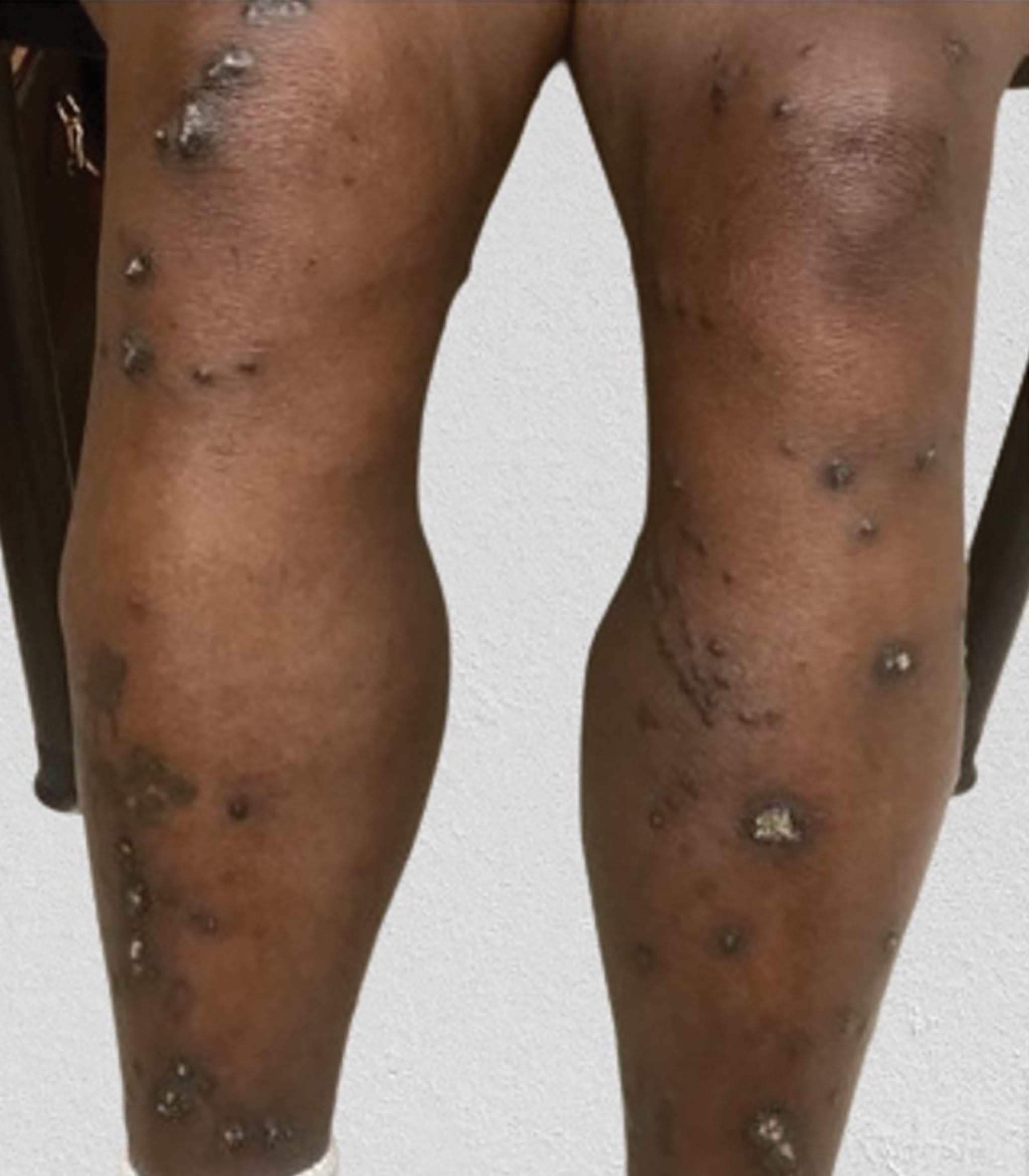 Abbildung: Patientin mit stark juckenden, harten Knötchen an den Beinen.   