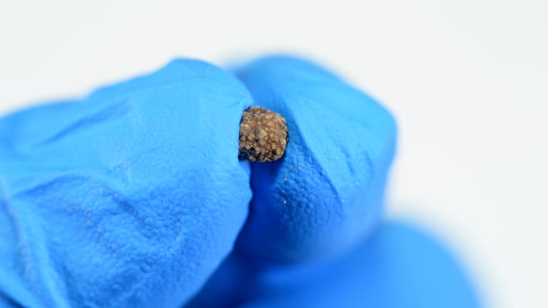 Bakterien integraler Bestandteil auch von Nierensteinen aus Kalziumoxalat