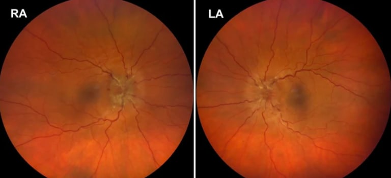 Beidseitige Papillenschwellung Abb. 1
