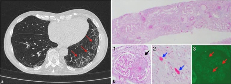 Abb. 1: a Thorax-CT (Computertomografie) mit Nachweis eines basal betonten ILD(„interstitial lung disease“)-Musters (rote Pfeile) ohne Hinweise für pulmonale Hämorrhagien. b Nierenbiopsie, Übersichtsbild (oben) mit Nachweis einer halbmondförmigen floriden intra- und extrakapillären Glomerulonephritis (Bild 1, schwarzer Pfeil zeigt auf das zelluläre glomeruläre Infiltrat) sowie intratubulären Erythrozytenzylindern (Bild 2, blaue Pfeile). Die Immunglobulin-G(IgG)-Immunfluoreszenz (Bild 3) zeigt ein nur schwac