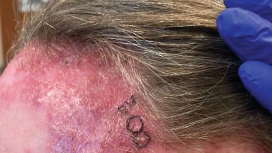 Alopezie und juckender Ausschlag an Stirn und Kopfhaut