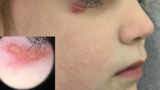 Schmerzloser Knoten am unteren Augenlid 