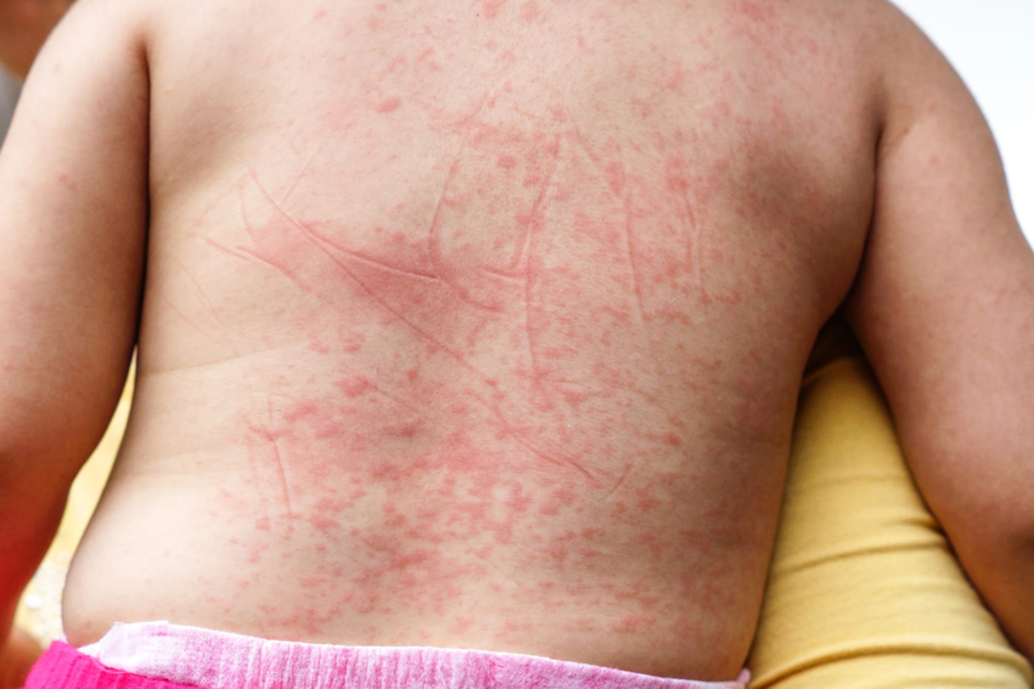 ExaKid Zeigt H ufige Kinderdermatologische Erkrankungen Coliquio exakid-zeigt-h-ufige-kinderdermatologische-erkrankungen-coliquio