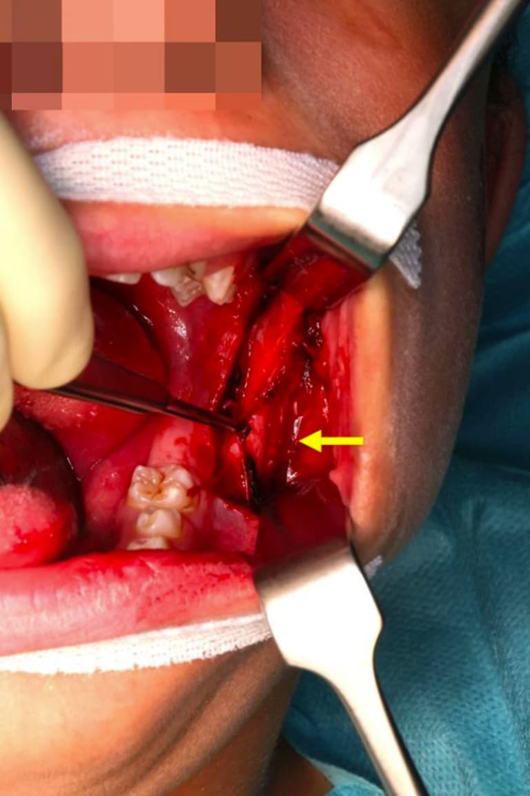 Operationssitus: supraperiostale Präparation der intramuskulären Raumforderung