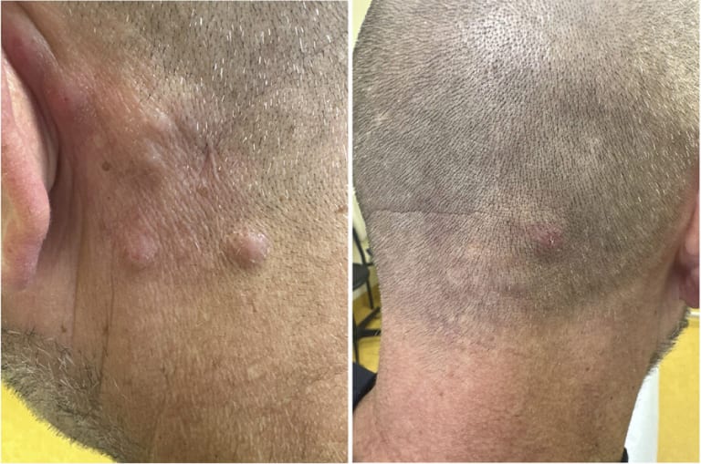 Hautveränderungen bei einem 50-jährigen männlichen Patienten, der wegen akuter lymphoblastischer B-Zell-Leukämie (B-ALL) mit Anti-CD19-CAR-T-Zellen behandelt wurde