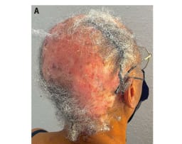 Ein extremer Fall von Lupus erythematodes 