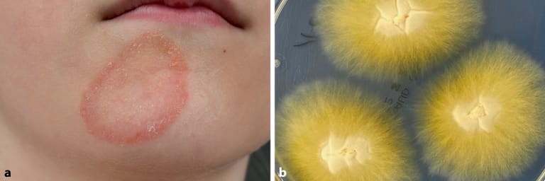 Pilzinfektionen der Haut bei Kindern