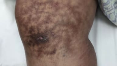 Netzartige Hyperpigmentierung am Bein