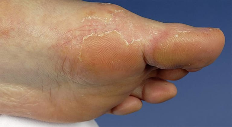 Pilzinfektionen der Haut bei Kindern