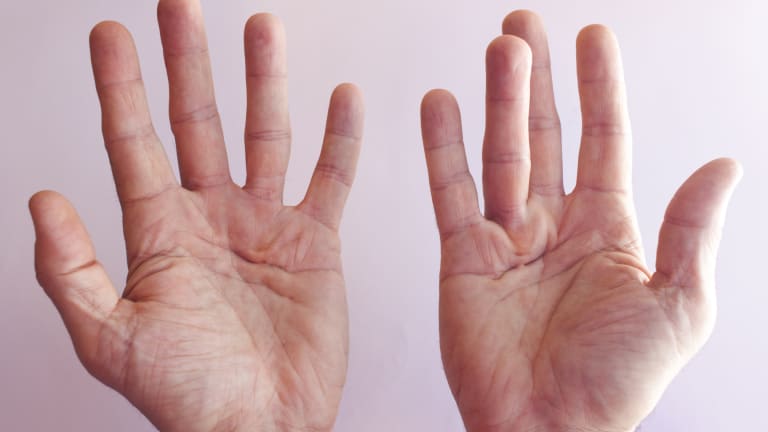 Fibroseerkrankungen der Hand