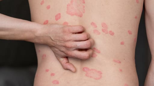 Psoriasis: Erhöhtes Krebsrisiko unter Biologika-Therapie?