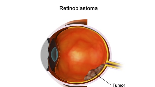 Retinoblastom