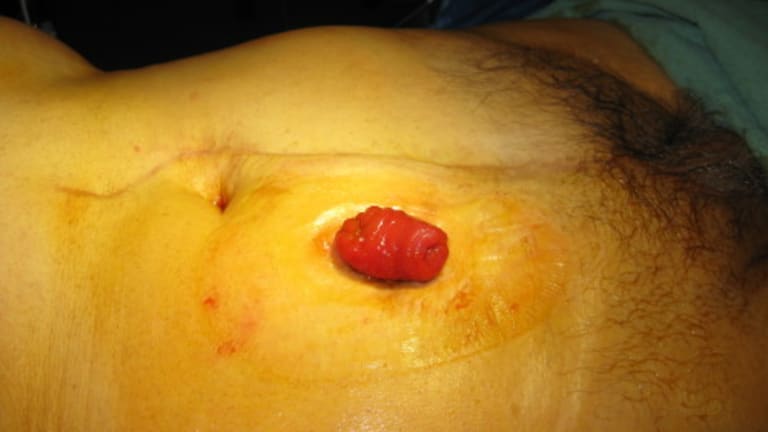 Ileostoma