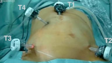 Sigmaresektion: Anlage des Pneumoperitoneums / Platzierung der Arbeitstrokare