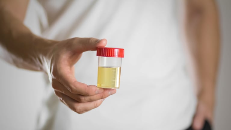 Aktive Überwachung des Prostatakarzinoms: Lassen sich durch Urintest Biopsien einsparen?