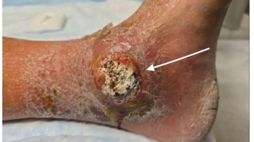 Erhabene, rundliche, ulzerierende Läsion mit kreideartigem Zentrum und umgebendem Erythem