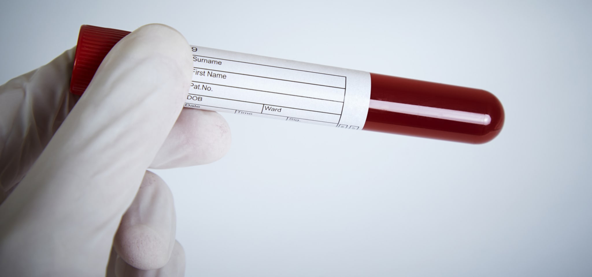 Blut im Urin Was steckt dahinter? coliquio